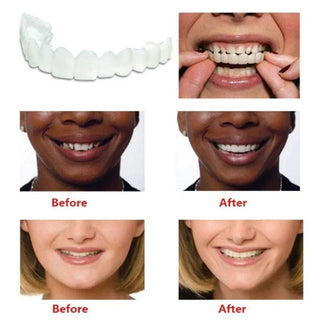 Instant Smile Veneers Snap on Teeth DIY Moldable Kit for Gaps Stains Missing Teeth